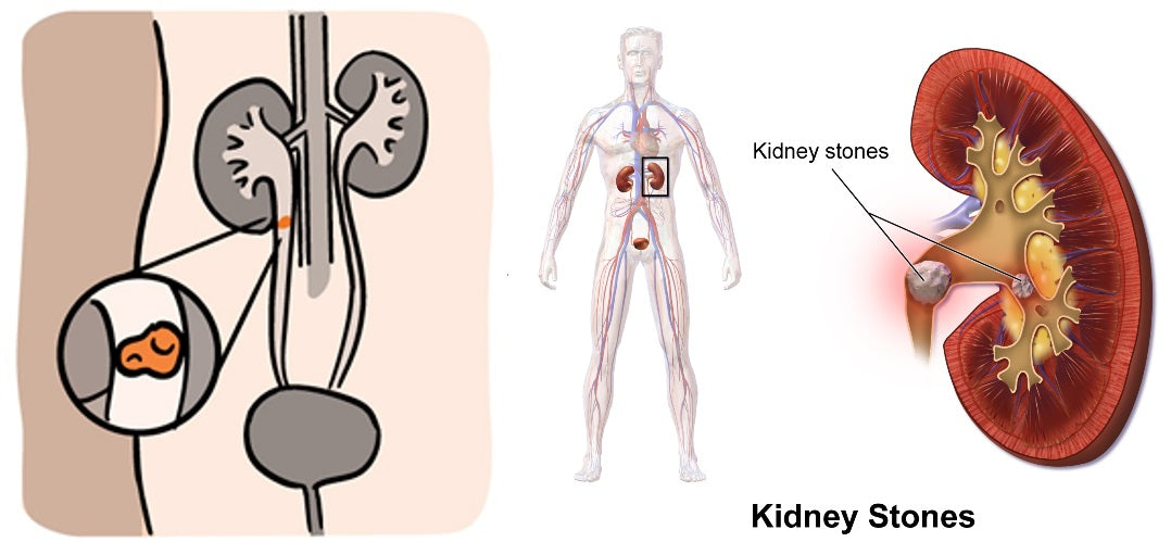 Don’t Just Take Chanca Piedra for Kidney Stones, Drink Lots of Water